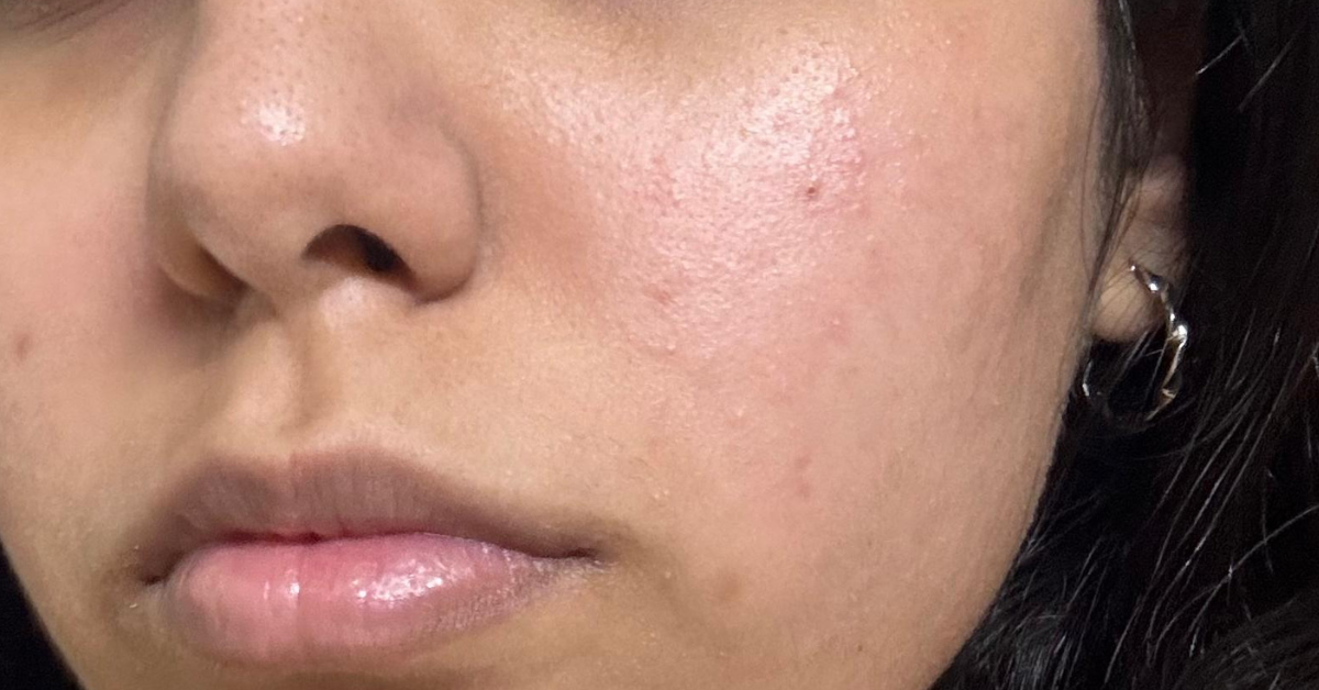 Reduce breakouts using 27's cleanser for acne prone skin
